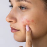 Can Acne Treatment reduce acne scars