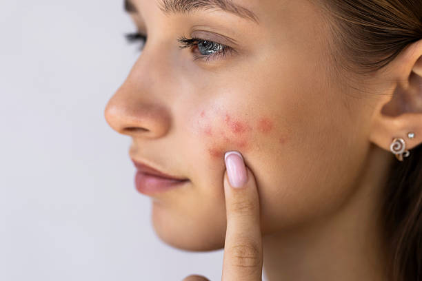 Can Acne Treatment reduce acne scars
