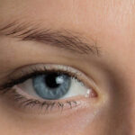 Can Eyelid Surgery Address Excess Eyelid Skin and Folds
