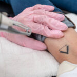 Can Laser Tattoo Removal Treat Colored Tattoos