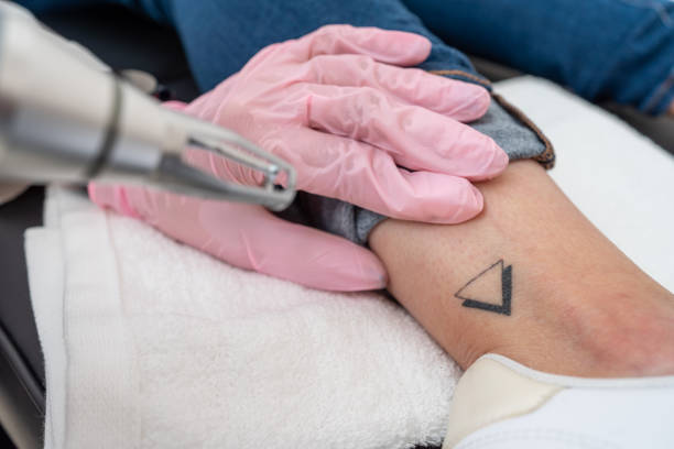Can Laser Tattoo Removal Treat Colored Tattoos