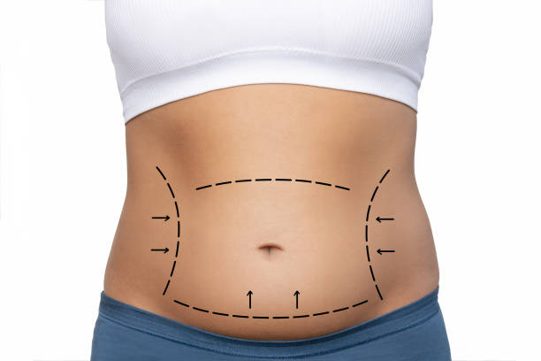 Can Mini Tummy Tuck Define the Lower Abdomen