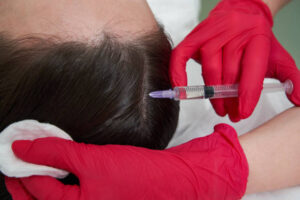 Can PRP Hair Treatment restore healthy hair growth