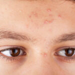 Does Acne Treatment help with blackheads