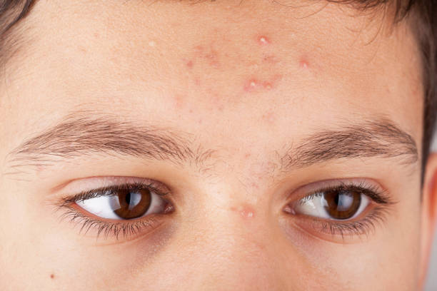 Does Acne Treatment help with blackheads