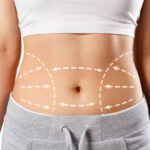 Does Body Lift help with loose skin on the thighs