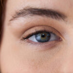 Does Eye Bag removal help with loose under-eye skin