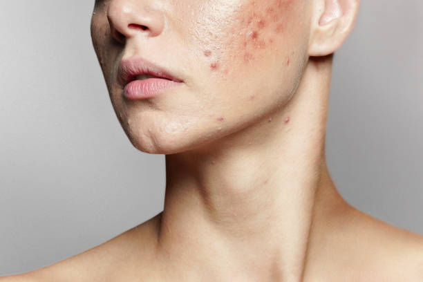 Does Laser Acne Scar Treatment Work on Acne Marks