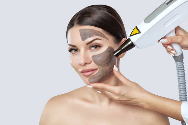 Does Laser Carbon Peel Brighten Tired-Looking Skin