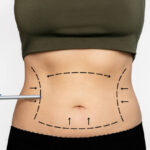 Does Laser Liposuction require much recovery time