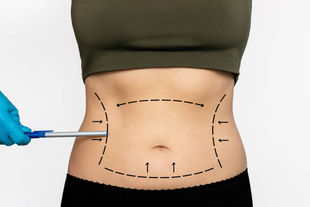 Does Laser Liposuction require much recovery time