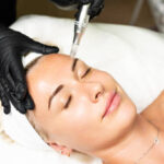Does Microneedling for Acne Scars Cause Lasting Redness