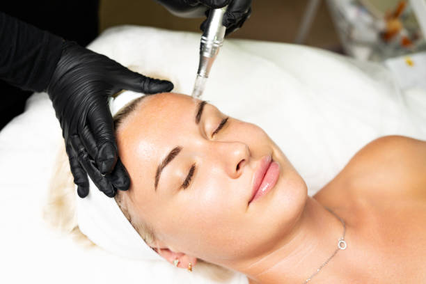 Does Microneedling for Acne Scars Cause Lasting Redness