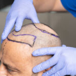 Does Scalp Micropigmentation Work With Existing Hair