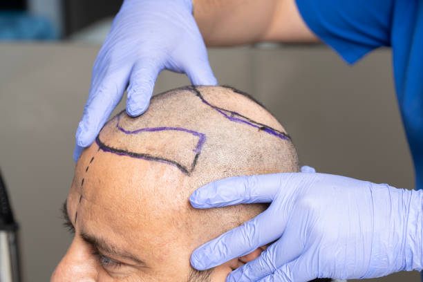 Does Scalp Micropigmentation Work With Existing Hair