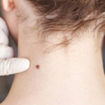 Does Skin Tag Removal Leave Scars on Your Skin