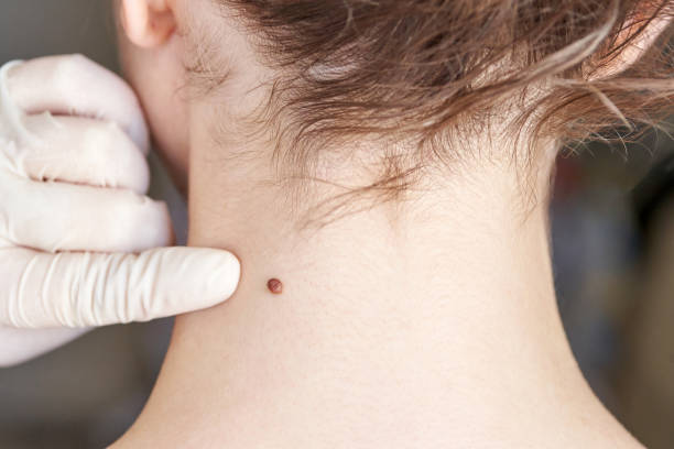 Does Skin Tag Removal Leave Scars on Your Skin