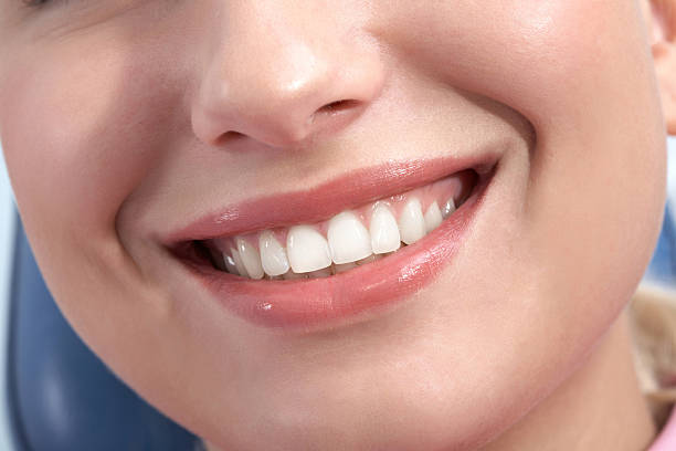 Does Teeth Whitening offer long-lasting bright results