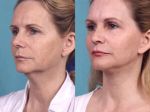Chemical Peel in Dubai