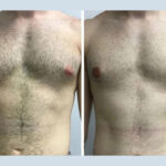 Gynecomastia in Dubai