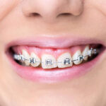 Young woman smiling after putting braces, dental procedure