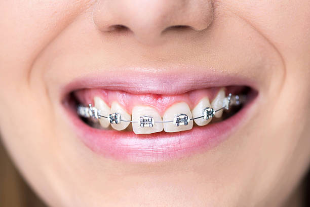 Young woman smiling after putting braces, dental procedure