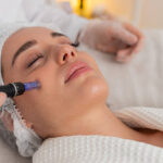 How Can Microneedling Improve Uneven Skin Tone Safely