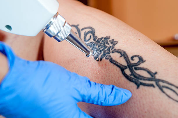 How Many Sessions Does Laser Tattoo Removal Need