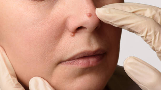 How Many Sessions Does Warts Removal Treatment Need