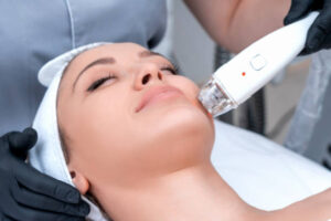 Is Fractional CO2 laser treatment safe for cheeks
