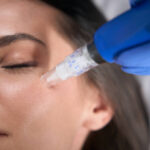 Is RF Micro Needling good for wrinkles
