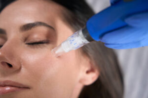 Is RF Micro Needling good for wrinkles