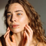 Is Laser Acne Scar Treatment Right for You