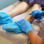 Is Laser Tattoo Removal permanent