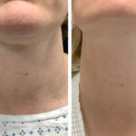 Radiofrequency (RF) Microneedling treatments in Dubai for Safe Rejuvenation