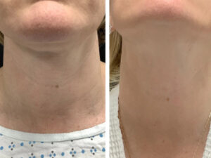 Radiofrequency (RF) Microneedling treatments in Dubai for Safe Rejuvenation