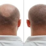 تكلفة زراعة الشعر في الرياض