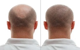 تكلفة زراعة الشعر في الرياض
