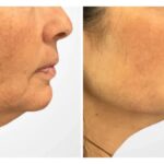 Thread Lift in Dubai Delivering Instant Lifting Effect