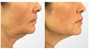 Thread Lift in Dubai Delivering Instant Lifting Effect