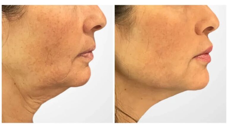 Thread Lift in Dubai Delivering Instant Lifting Effect