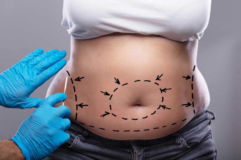 Tummy Tuck Dubai: Who Is the Right Candidate for Abdominoplasty?