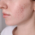 Can Acne Treatment Clear Stubborn Breakouts