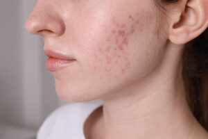 Can Acne Treatment Clear Stubborn Breakouts