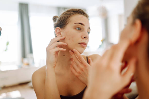Can Acne Treatment Improve Acne-Prone Skin Over Time