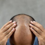 Can GFC Treatment for Hair improve hairline density