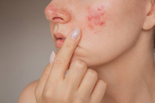 Can Laser Acne Scar Treatment Fade Old Acne Scars