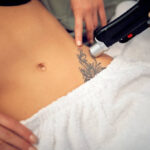 Can Laser Tattoo Removal Remove Colored Tattoos