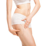 Can Lower Body Lift reduce skin folds around the waist