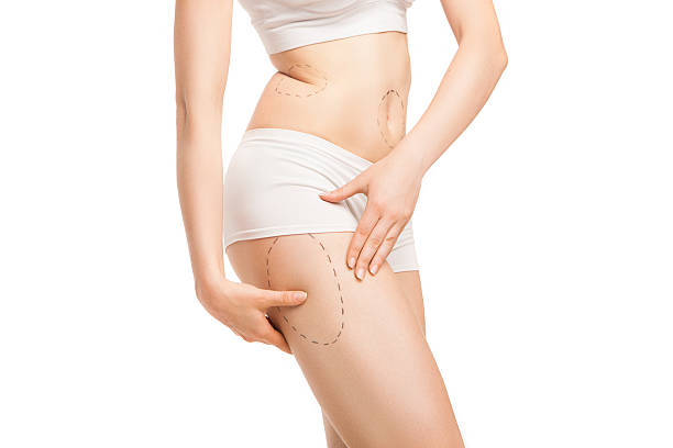 Can Lower Body Lift reduce skin folds around the waist